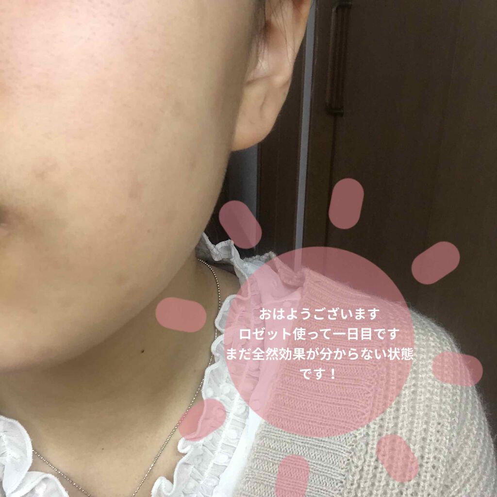 ロゼット洗顔パスタ アクネクリア/ロゼット/洗顔フォームを使ったクチコミ（1枚目）