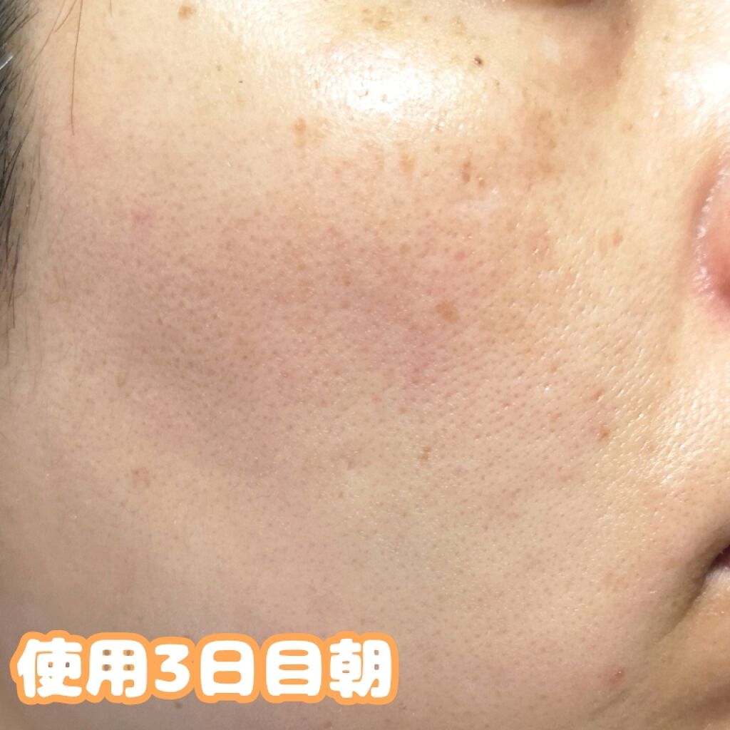 アレルバリア エッセンス BB/d プログラム/BBクリームを使ったクチコミ(2枚目)