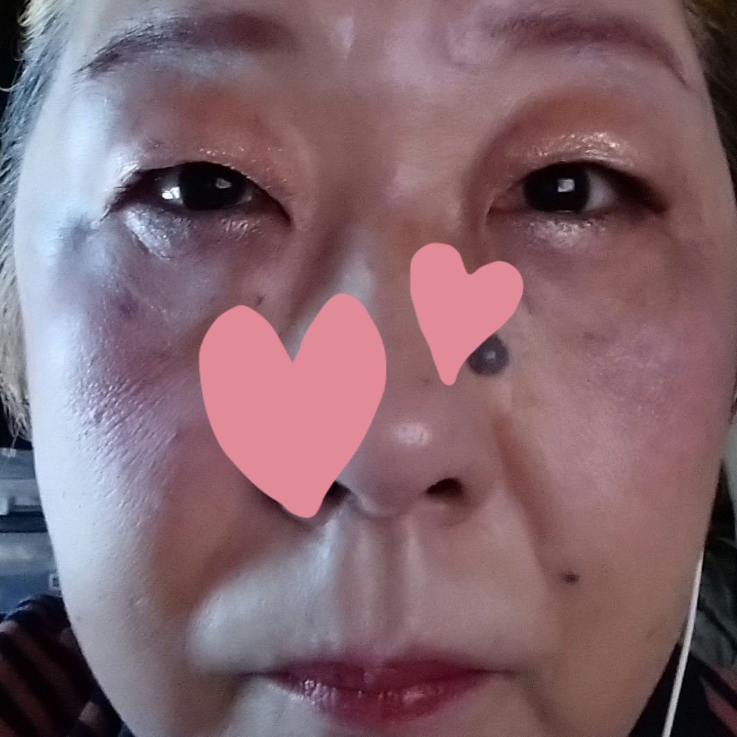 フィットミー リキッド ファンデーション DN/MAYBELLINE NEW YORK/リキッドファンデーションを使ったクチコミ（3枚目）