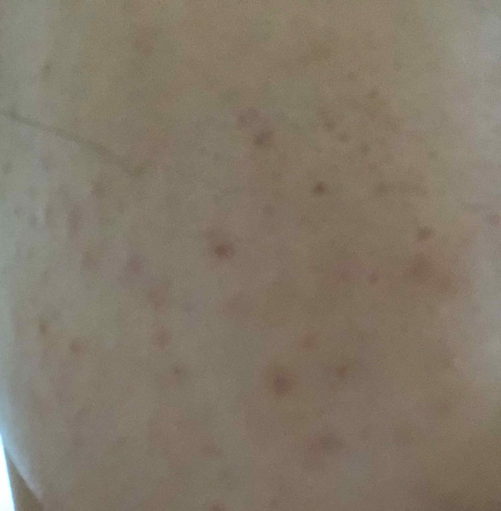 ミノン アミノモイスト 薬用アクネケア ローション/ミノン/化粧水を使ったクチコミ（3枚目）