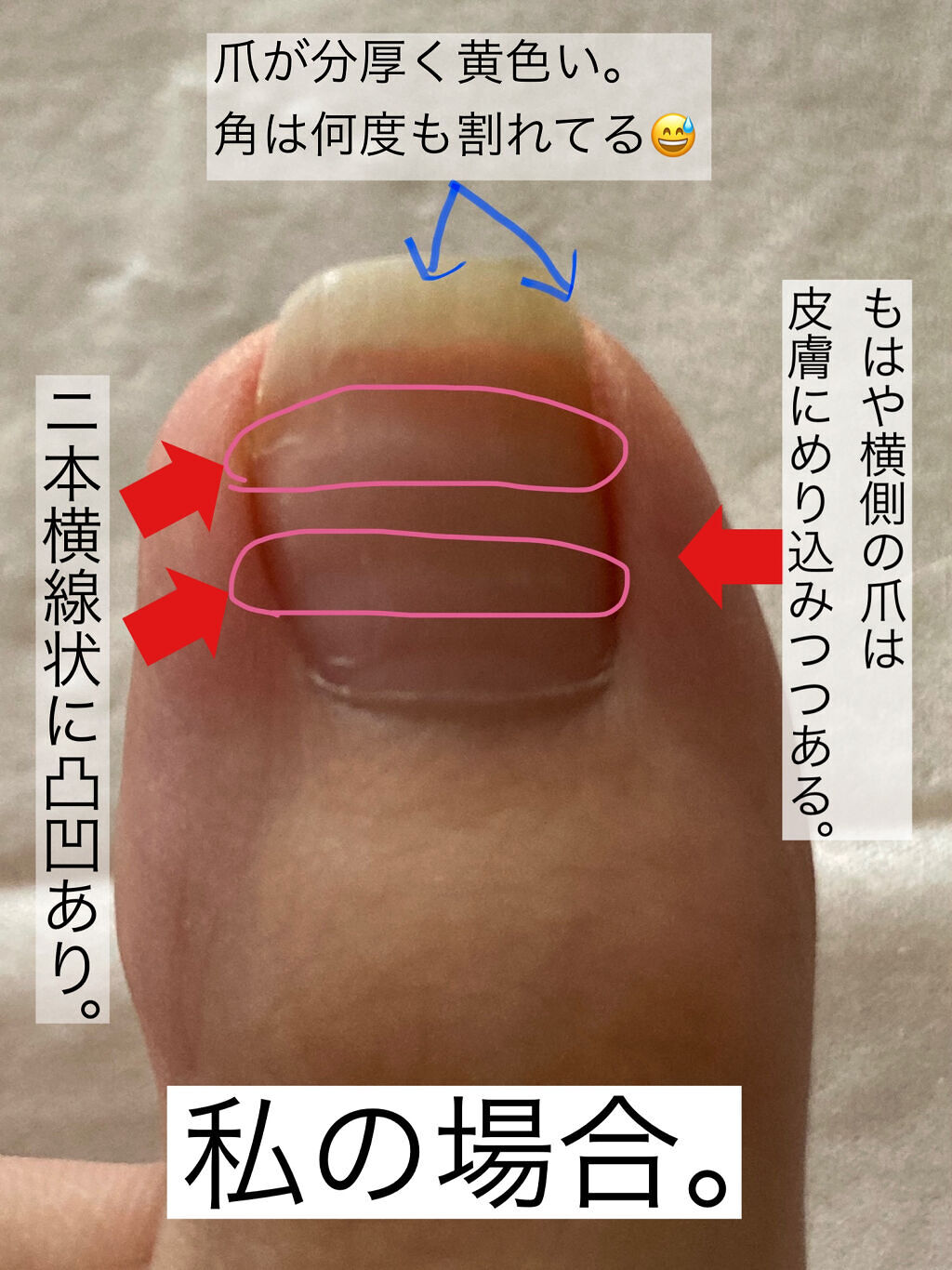 バトルウィン セラポアテープ(キネシオロジーテープ)/ニチバン/その他を使ったクチコミ（2枚目）