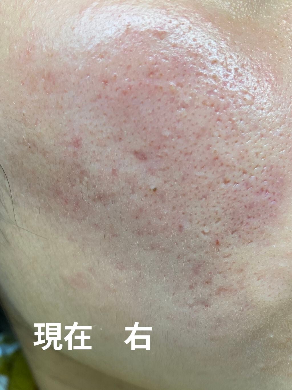 テラ・コートリル 軟膏(医薬品)/ジョンソン・エンド・ジョンソン/その他を使ったクチコミ(5枚目)