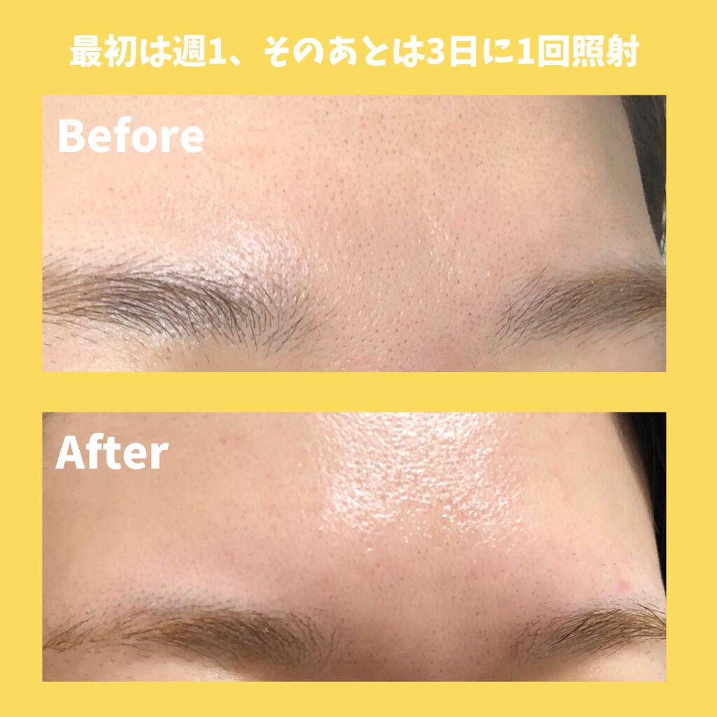 光美容器 光エステ ボディ&フェイス用 ハイパワー ゴールドES-CWP97-N/Panasonic/家庭用脱毛器を使ったクチコミ(3枚目)