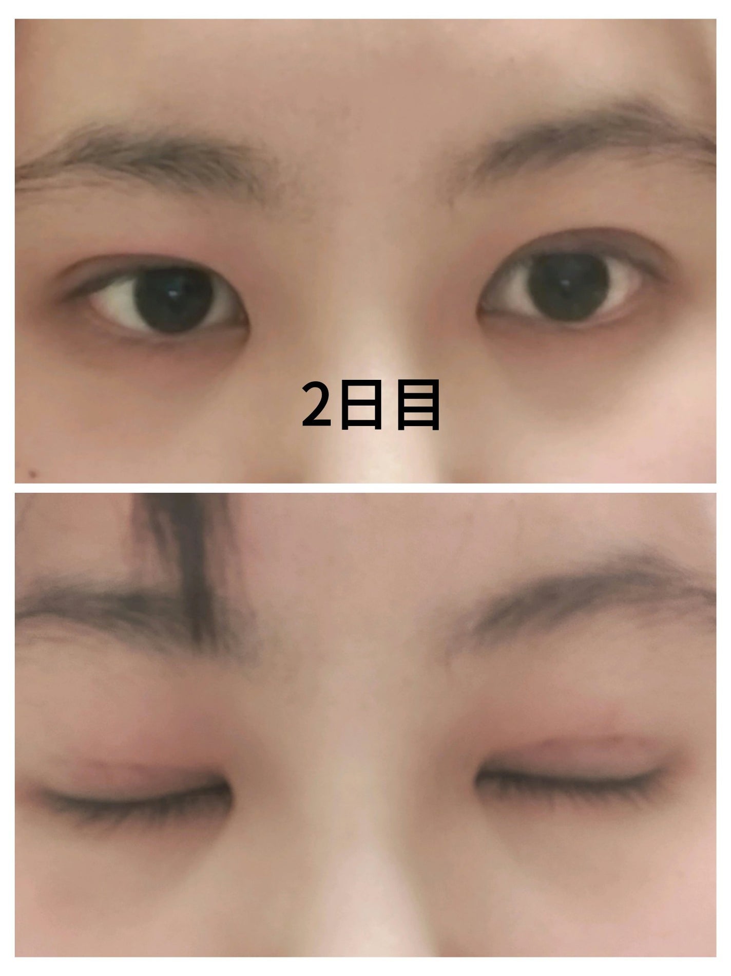 kaira on LIPS 「二重整形しちゃいました🤭今までも何度か二重の投稿をさせてもらっ..」(3枚目)