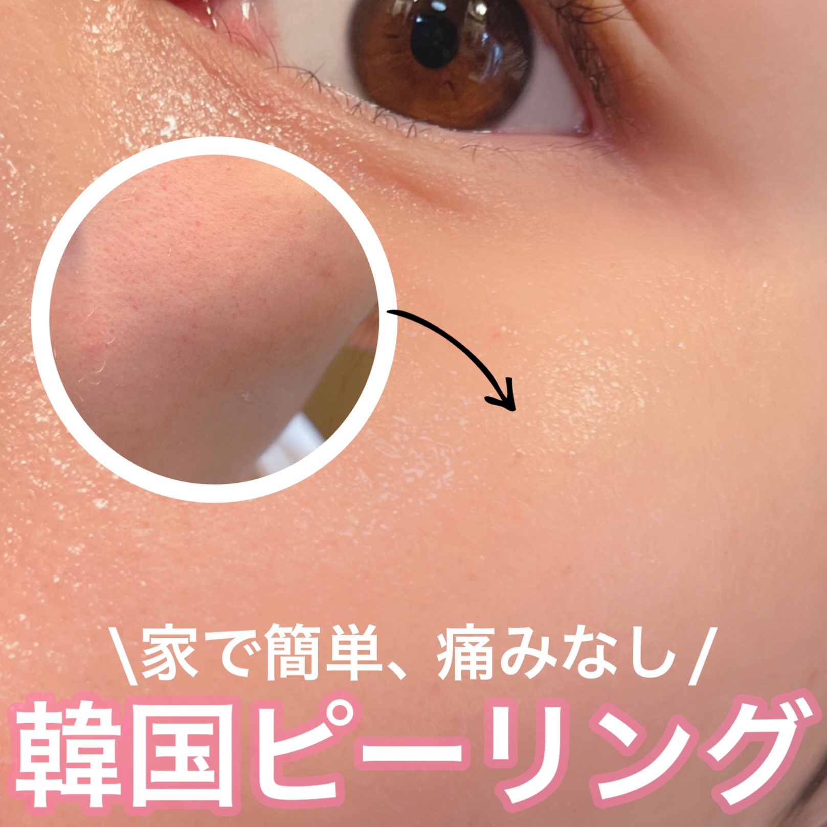 ダーマスキンピーリング/BQCELL/その他キットセットを使ったクチコミ（1枚目）