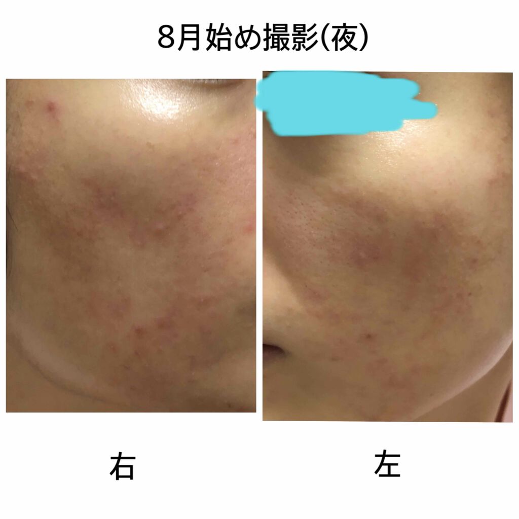 ハトムギ化粧水(ナチュリエ スキンコンディショナー R )/ナチュリエ/化粧水を使ったクチコミ（2枚目）