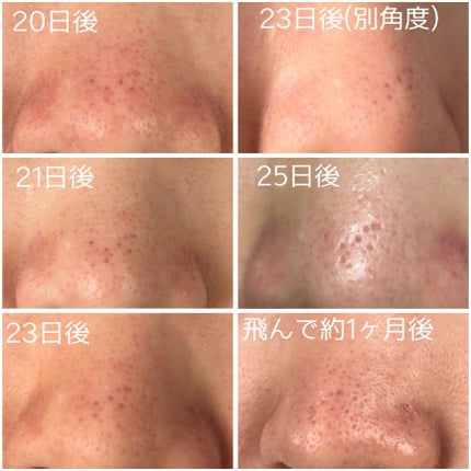 イチジク毛穴アンプル/Veganifect/美容液を使ったクチコミ(4枚目)