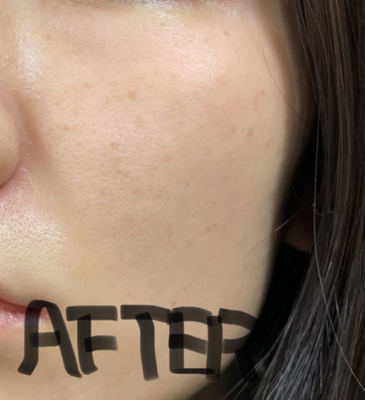 トレチノインジェル/A-Ret/美容液を使ったクチコミ（3枚目）