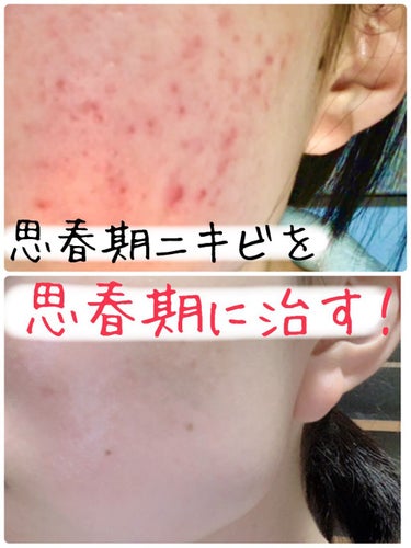 🍋れもん🍋フォロバ100 on LIPS 「思春期ニキビを思春期に治す！（自分語り→早く方法が見たい人は飛..」（1枚目）