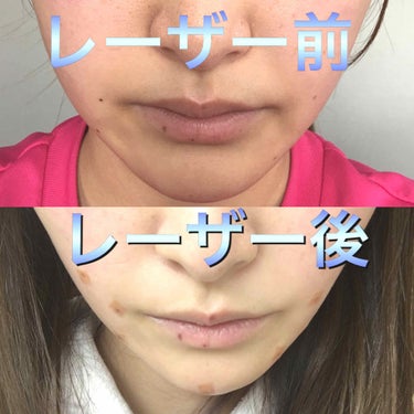 みす on LIPS 「私はほくろが出来やすく、ここ何年かでほくろが増えてきたのでピコ..」（2枚目）