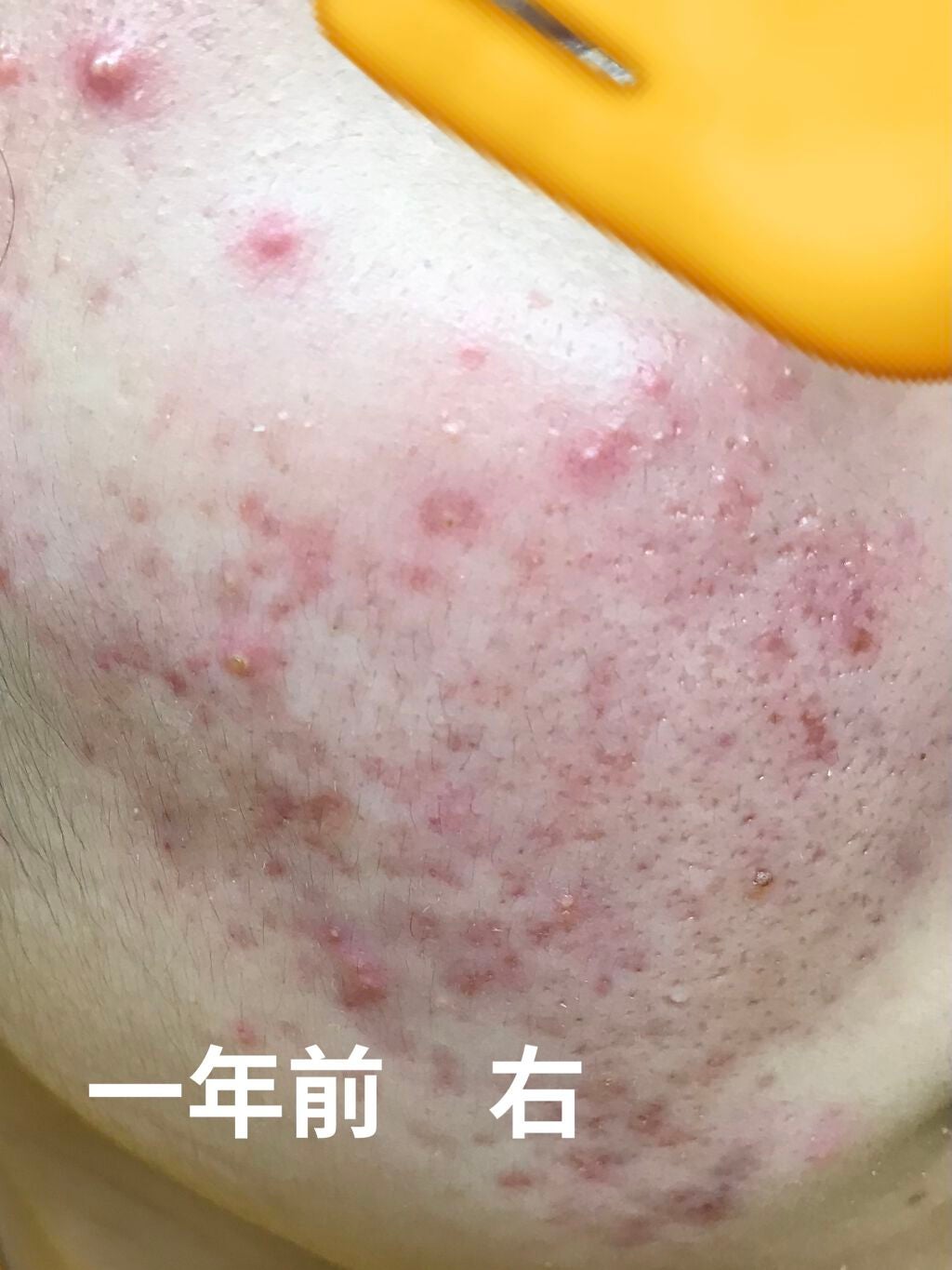 テラ・コートリル 軟膏(医薬品)/ジョンソン・エンド・ジョンソン/その他を使ったクチコミ(4枚目)