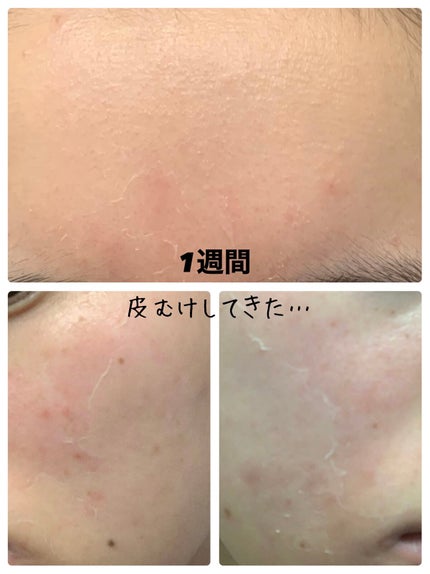 EUKROMA ハイドロキノンクリーム4% 20g/EUKROMA/その他スキンケアを使ったクチコミ(3枚目)