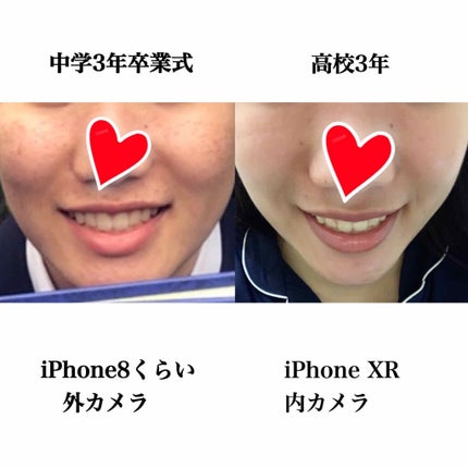 ビーソフテン ローション(医薬品)/持田製薬/その他を使ったクチコミ(2枚目)