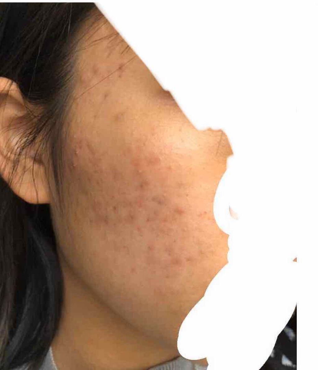 ハトムギ化粧水(ナチュリエ スキンコンディショナー R )/ナチュリエ/化粧水を使ったクチコミ（3枚目）