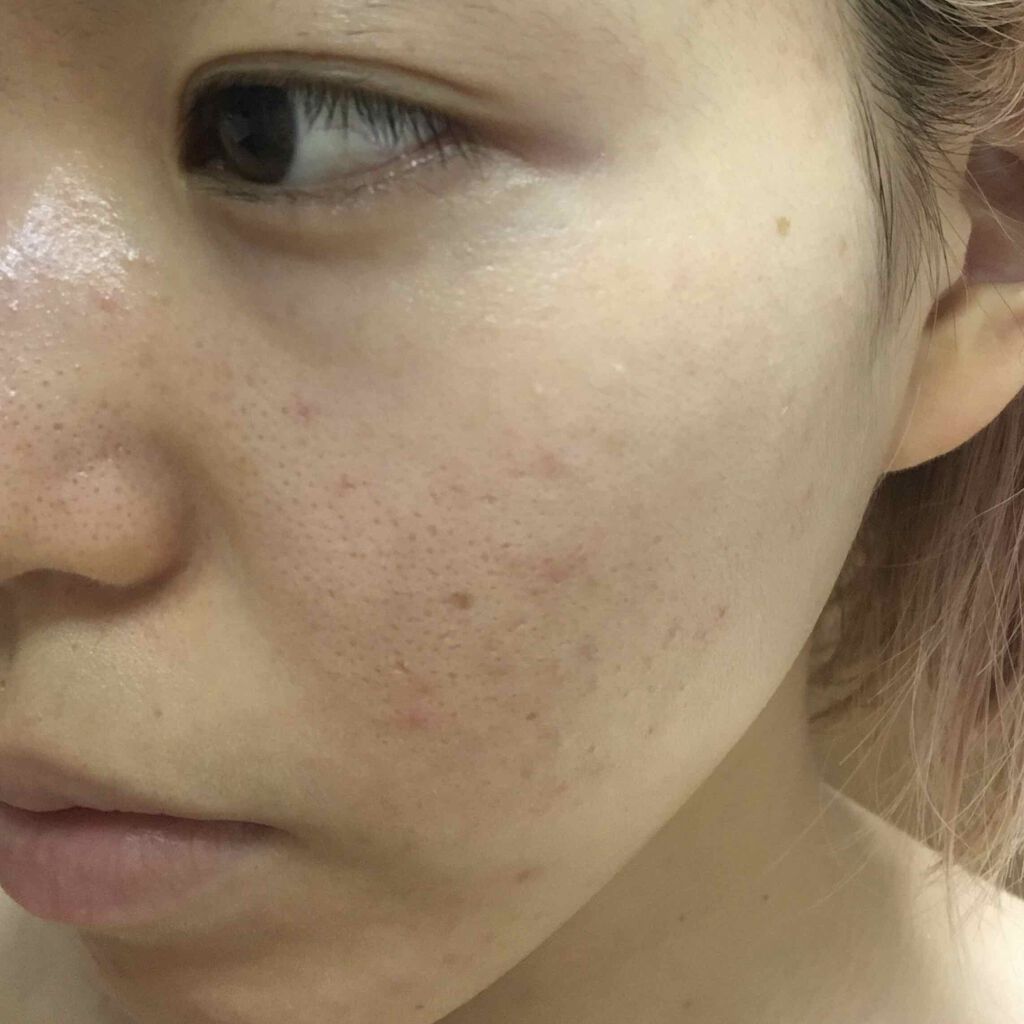 ペアアクネクリームW(医薬品)/ペア/その他を使ったクチコミ（2枚目）