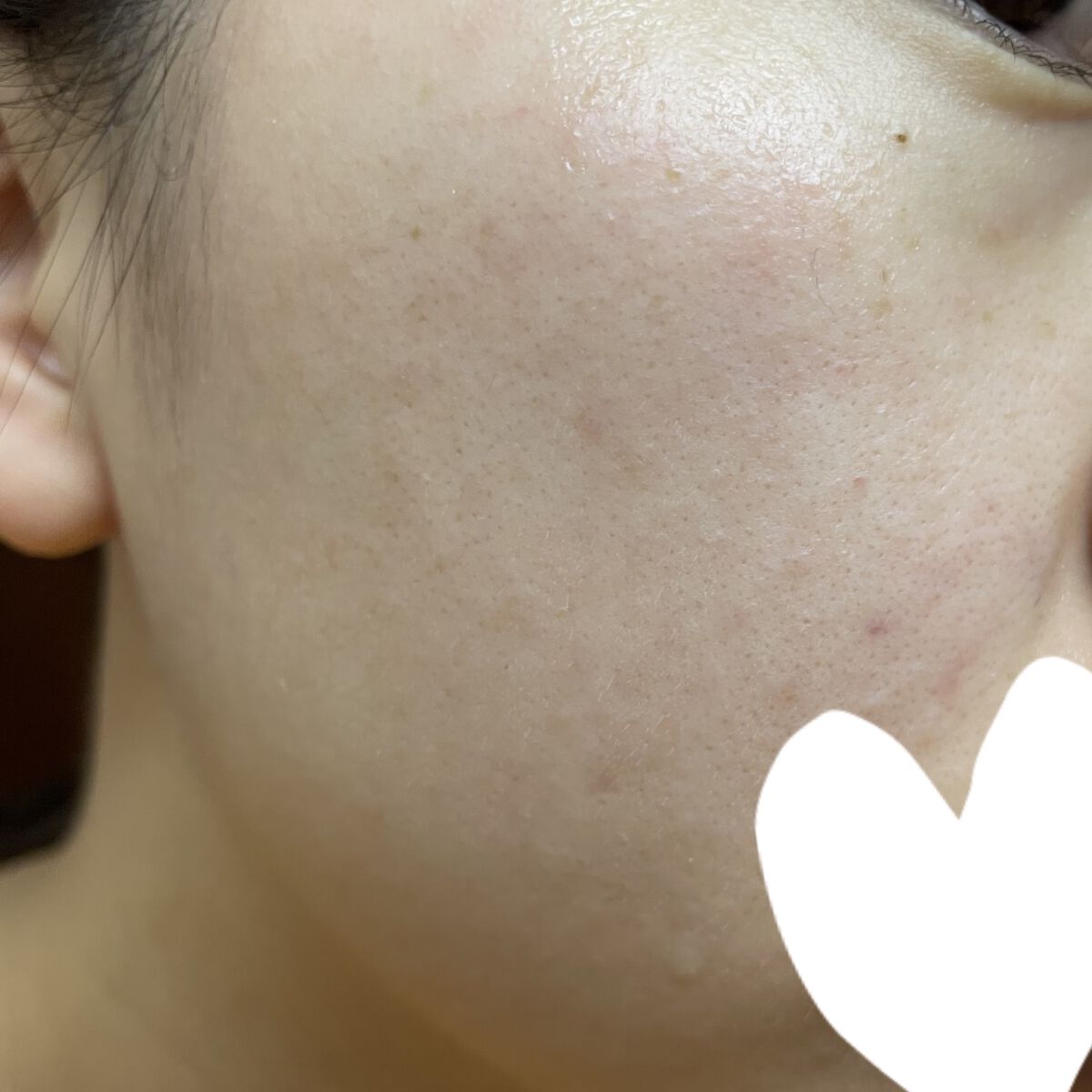 薬用 しみ 集中対策 美容液/メラノCC/美容液を使ったクチコミ（1枚目）
