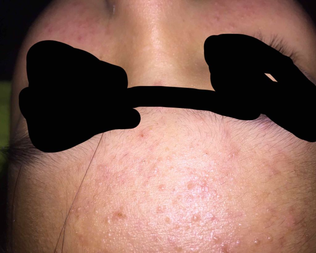 orange_rouge_bgs on LIPS 「このニキビ肌どうしたら治りますか??洗顔はロゼットの水色、その..」(2枚目)