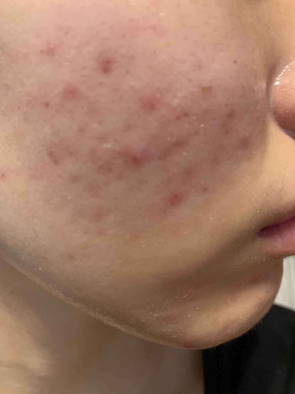 ベピオゲル/マルホ株式会社/その他を使ったクチコミ（1枚目）