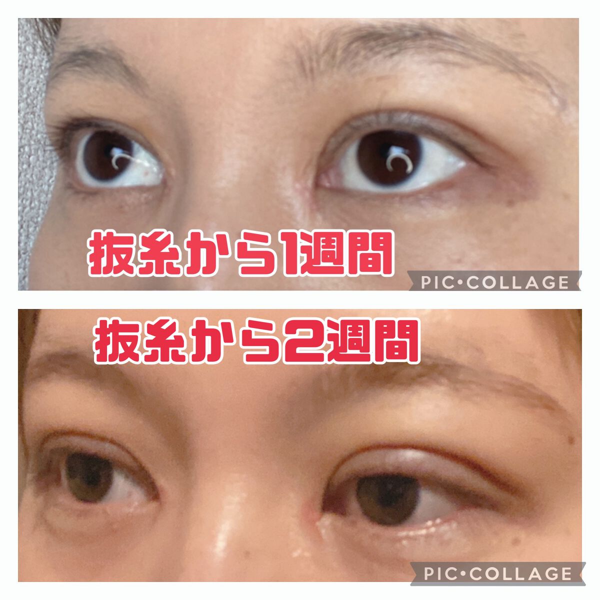 ふうせん @フォロバ100% on LIPS 「3月17日抜糸から2週間今日は、ちょっと腫れてました。その日の..」(4枚目)