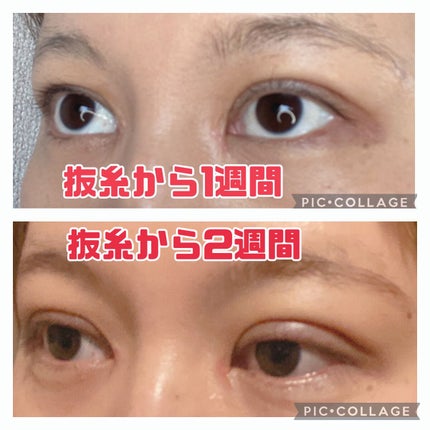 ふうせん @フォロバ100% on LIPS 「3月17日抜糸から2週間今日は、ちょっと腫れてました。その日の..」(4枚目)