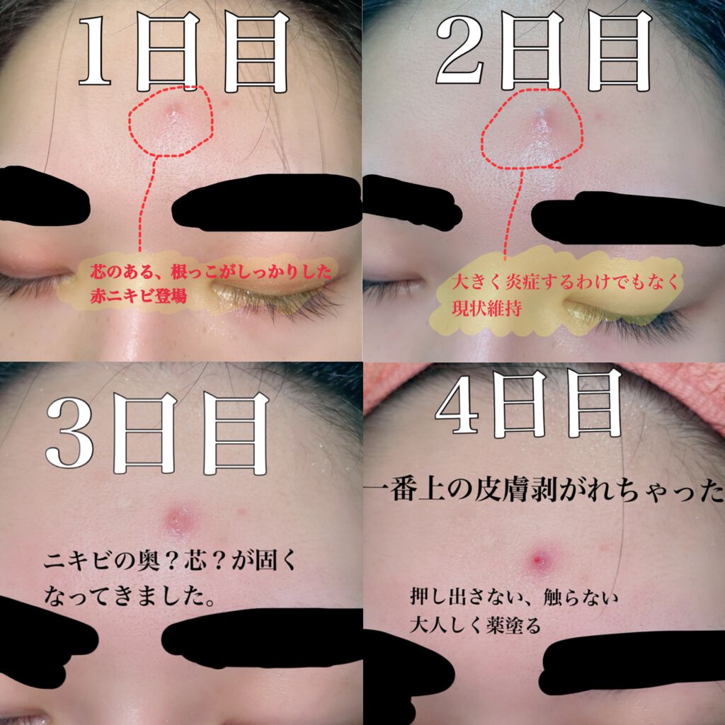 ペアアクネクリームW(医薬品)/ペア/その他を使ったクチコミ（3枚目）