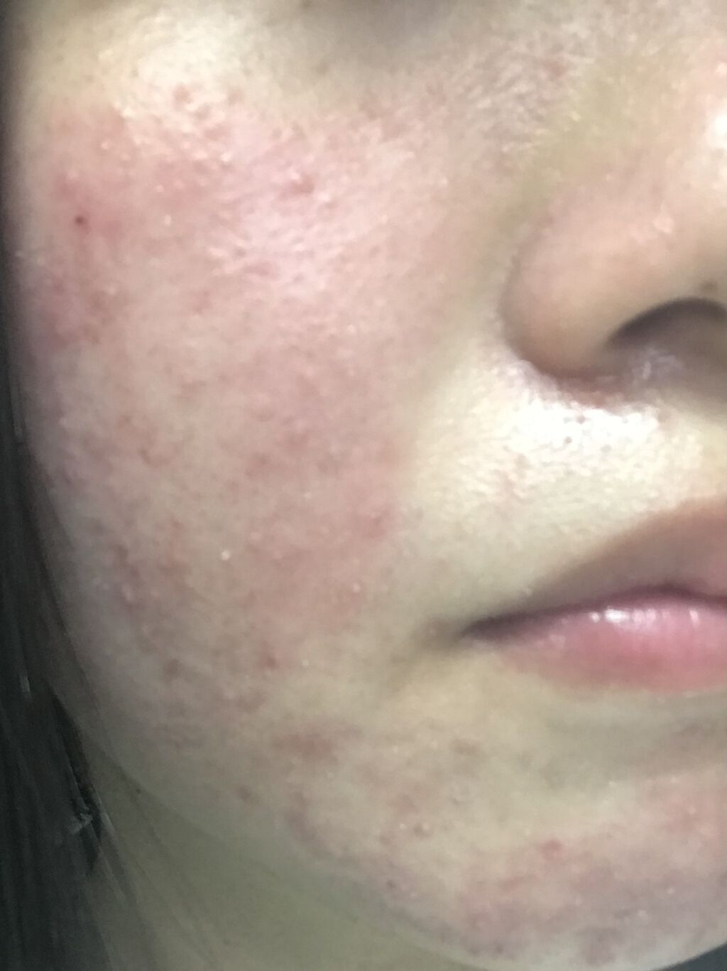 エピデュオゲル/マルホ株式会社/その他を使ったクチコミ（1枚目）