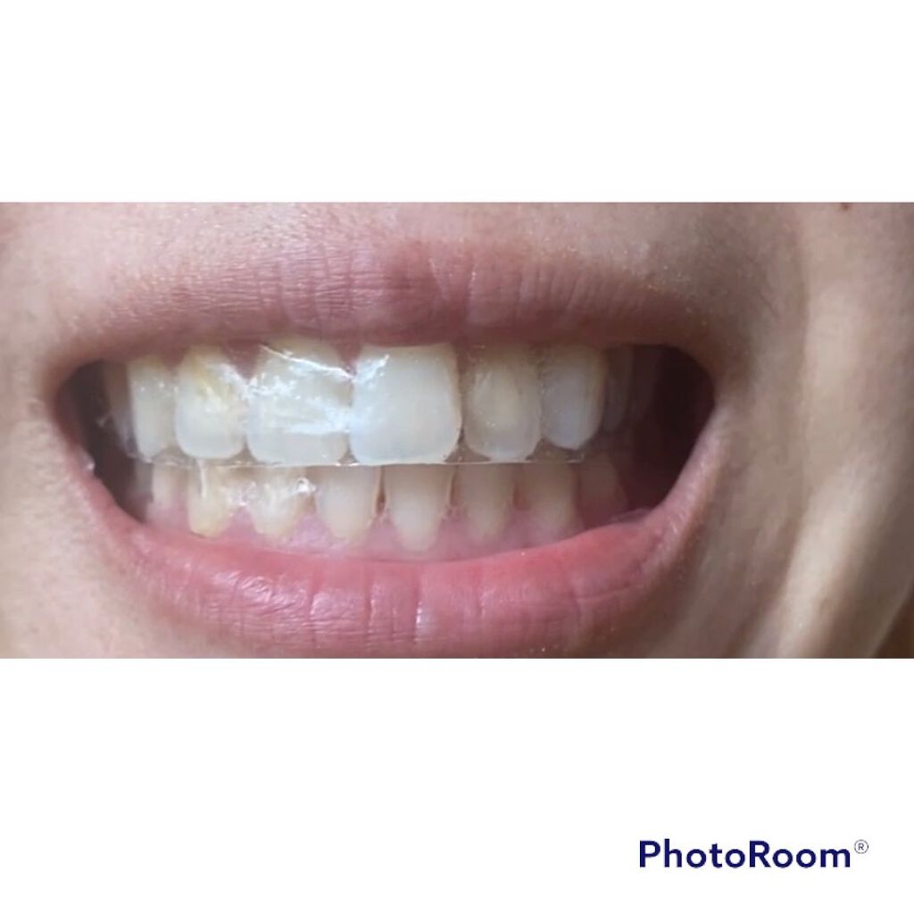 ふうせん @フォロバ100% on LIPS 「自宅で簡単にセルフホワイトニング始めてみませんか!?THE歯の..」(4枚目)