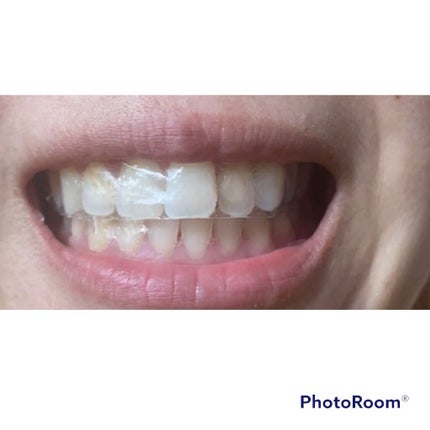 ふうせん @フォロバ100% on LIPS 「自宅で簡単にセルフホワイトニング始めてみませんか!?THE歯の..」(4枚目)