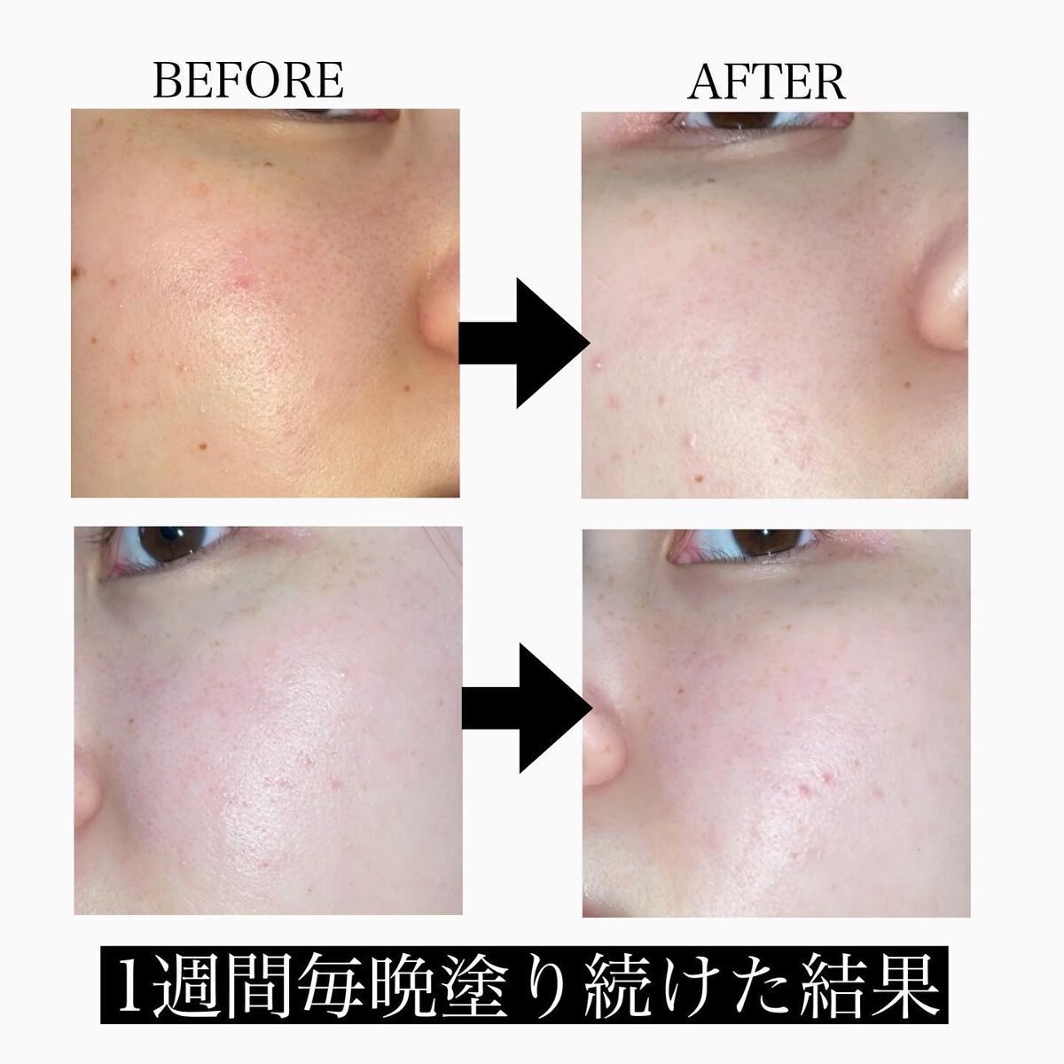 レチノールインテンスリアクティベーションセラム/SOME BY MI/美容液を使ったクチコミ（3枚目）