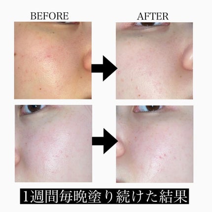 レチノールインテンスリアクティベーションセラム/SOME BY MI/美容液を使ったクチコミ(3枚目)