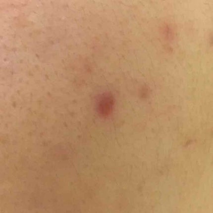 薬用 しみ 集中対策 美容液/メラノCC/美容液を使ったクチコミ(2枚目)