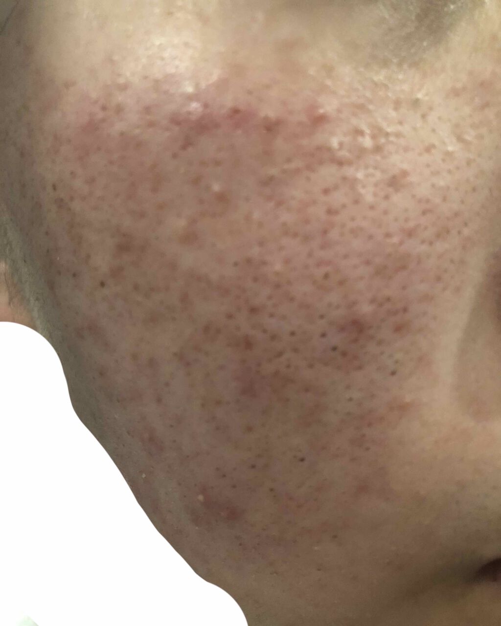 らら on LIPS 「助けてください(;;)今年の3月頃の花粉がキツくなってきたあた..」(4枚目)