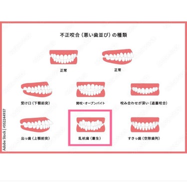 ぽむ on LIPS 「歯列矯正についてお話します！！私は一昨年の10月から歯列矯正を..」（3枚目）