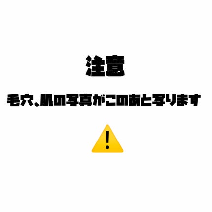 アゼライン酸15 インテンスカーミングセラム/Anua/美容液を使ったクチコミ(3枚目)