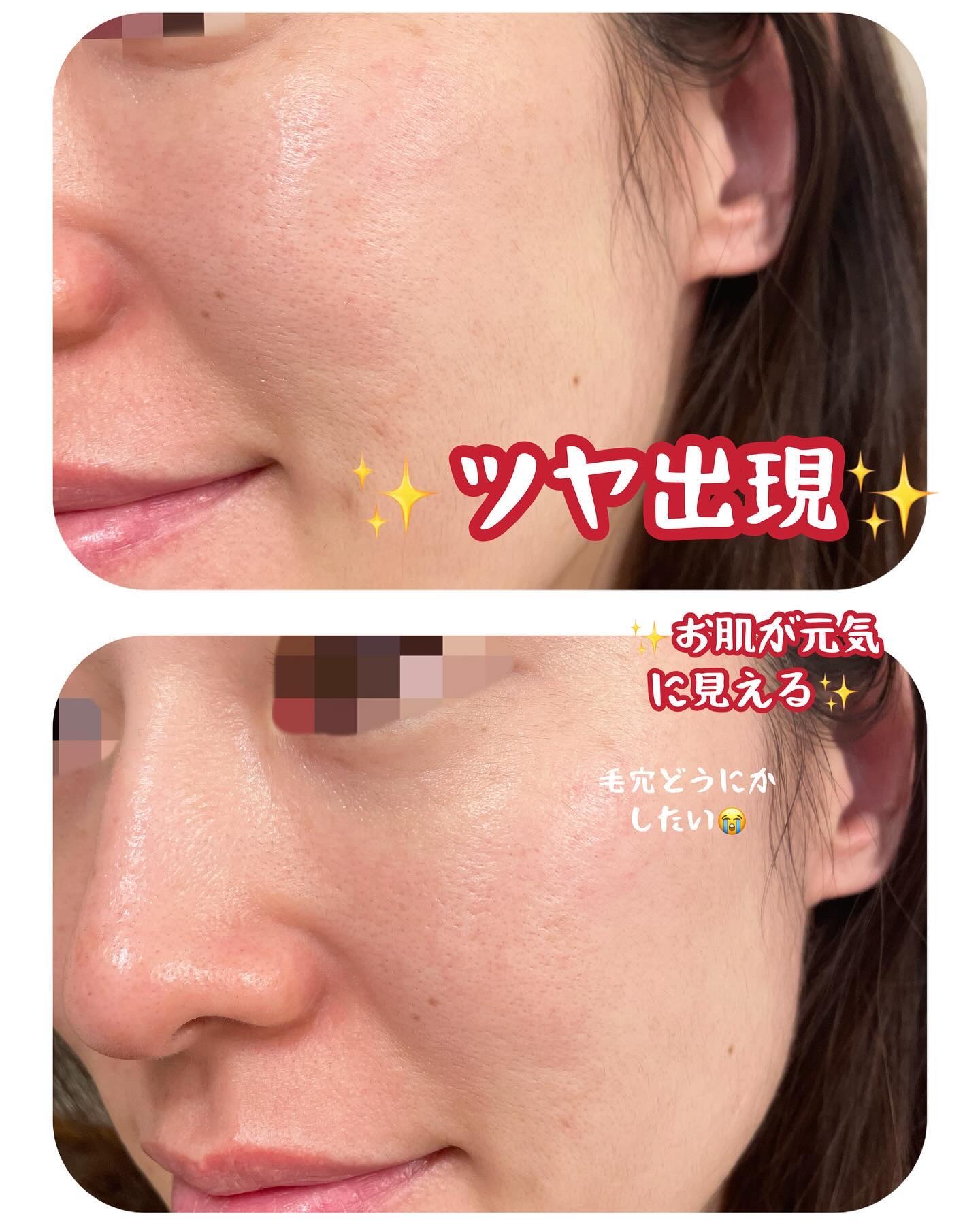 極潤 薬用ハリ化粧水【医薬部外品】 本体/肌ラボ/化粧水を使ったクチコミ（3枚目）