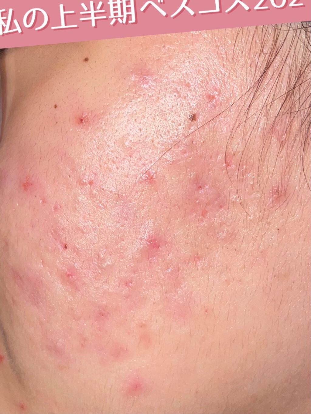 ミノン アミノモイスト モイストチャージ ミルク/ミノン/乳液を使ったクチコミ(2枚目)