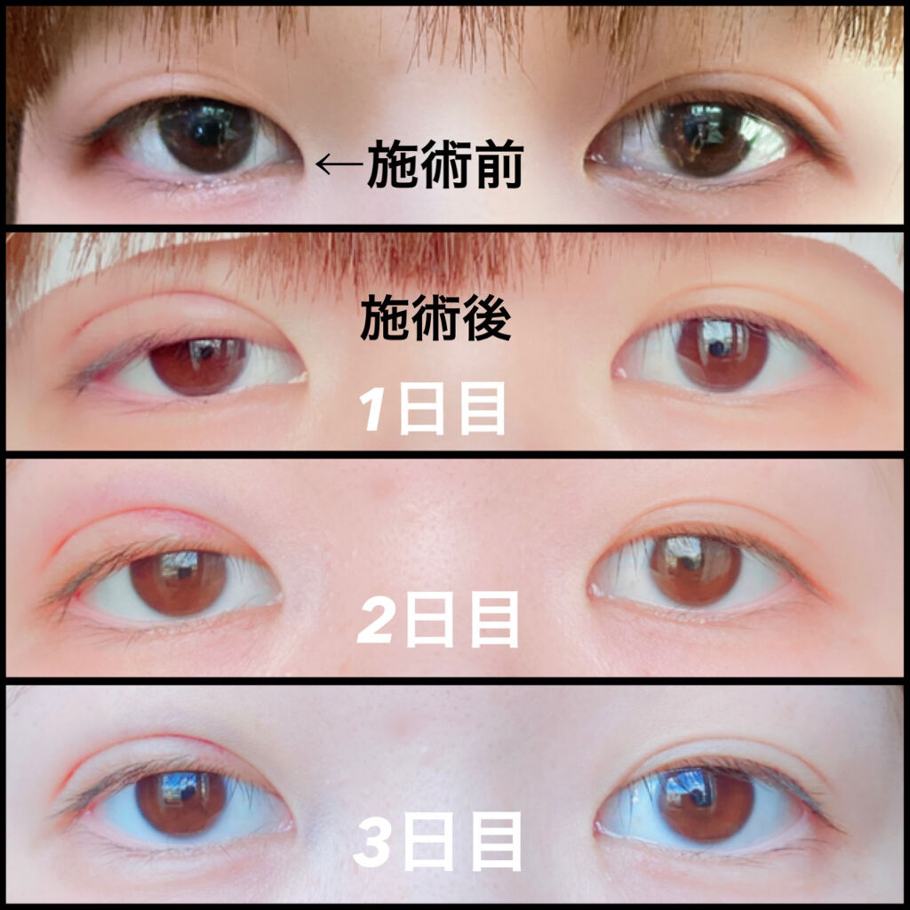 二重整形/その他を使ったクチコミ（2枚目）