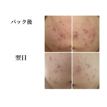 【LIHAW モイストリペアマスク】を使用してみた！✨
（🚨3枚目に肌荒れの画像が出ます。）


この前までVT CICA スリーピングマスクの使用感についてレポをしていましたが、効果が思っていたより出ませでした。。。

そこで次はニキビケアのために【LIHAW モイストリペアマスク】を使ってみました^ - ^

昨日使い、翌日の感想
→良い！！！
赤みが引いてる感じがある。おでこにできてた、ぷつぷつ消えてる。頬のデカニキビは、気持ち小さくなったかも？！翌日すぐになくなるなんてことはないけど、続けていけば、鎮静されそう！
また、ニキビができない箇所をキュッと引き締まってた感ある！


VT CICAデイリースージングマスクも、一昨日まで一定期間毎日使用していましたが、正直VTよりこっちの方が効果でてる！LIHAWは、美容液たっぷりなのにさっぱりしてる！VTのほうは、肌が調子良くなってきたら肌荒れ予防に使おうかな？って思ってます。

私の肌的に重めの美容液は荒れる傾向にあります。
キュレルはニキビできるし、メディヒールも効果なしの肌なので、こういうさっぱり系が好きです！♡

いろんな口コミをみて、保湿感があまりないというのをよくみましたが、私は保湿感あって良いと感じました。

確かに香りは独特だけど、つけてるうち慣れます。
今の所ダメなところは見つからない。

#LIHAW #モイストリペアマスク #パック #肌荒れ #ニキビ #赤み_鎮静 #赤みの画像 その2