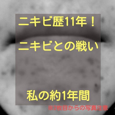 こんにちは。ニキビ歴11年の女の投稿です！ この1年色んな化粧品を試して、私が気づいたことを投稿したいと思います。

早速ですが、ニキビを減らす上で1番重要だと思ったのは、しっかり肌質を知ることでした。