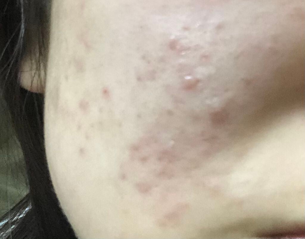 みおん on LIPS 「みなさん助けてください…ニキビ跡がこんなに残ってます😢これでも..」(1枚目)