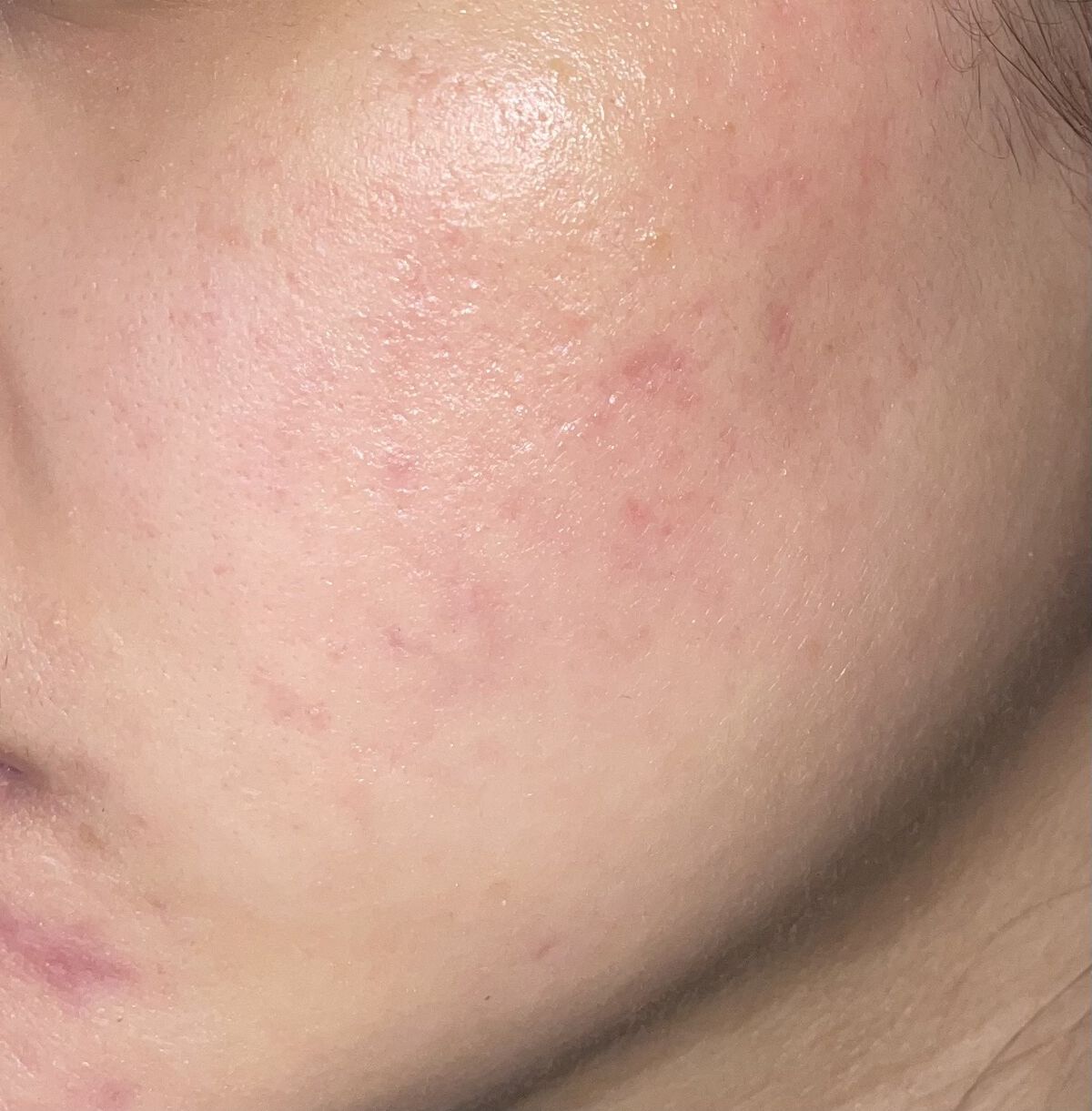 アダパレンゲル/日本ジェネリック/その他を使ったクチコミ（3枚目）