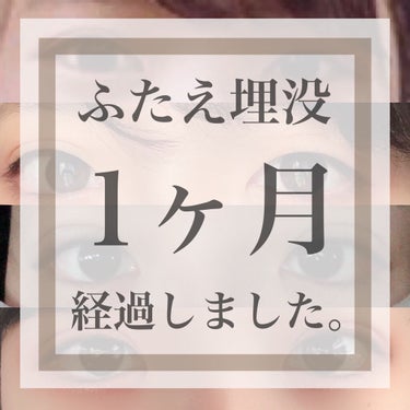 ＼ふたえ整形1ヶ月経過／

こんにちは！はるるです🐯
今回は、12/22にやった埋没の手術から
1ヶ月経過したので、
いまの目元と、経過を動画にしたので
公開します😃

🌷🌷🌷🌷🌷🌷🌷🌷🌷🌷🌷🌷🌷🌷🌷🌷