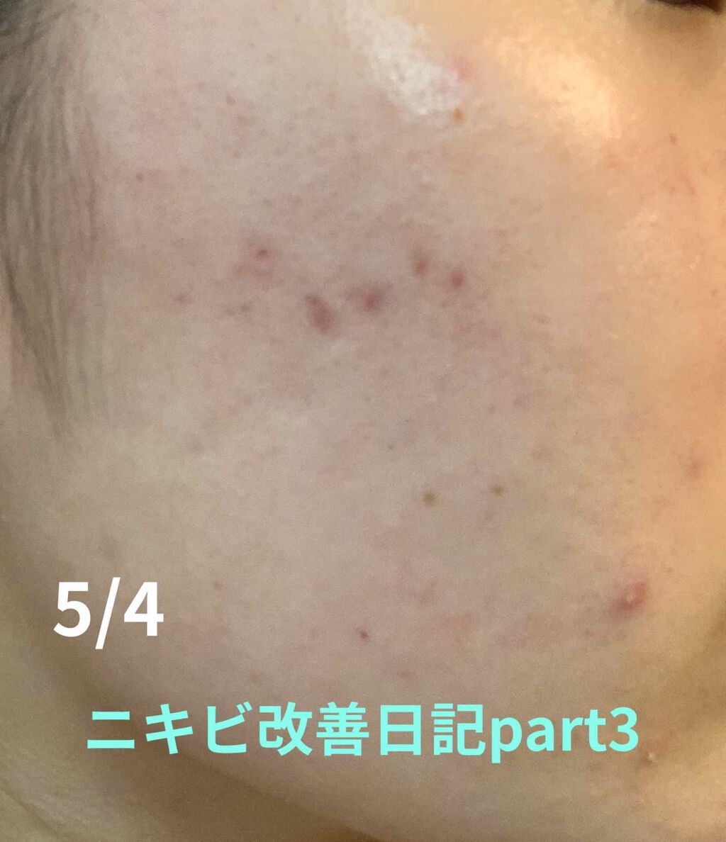 ミノン アミノモイスト 薬用アクネケア ローション/ミノン/化粧水を使ったクチコミ（1枚目）