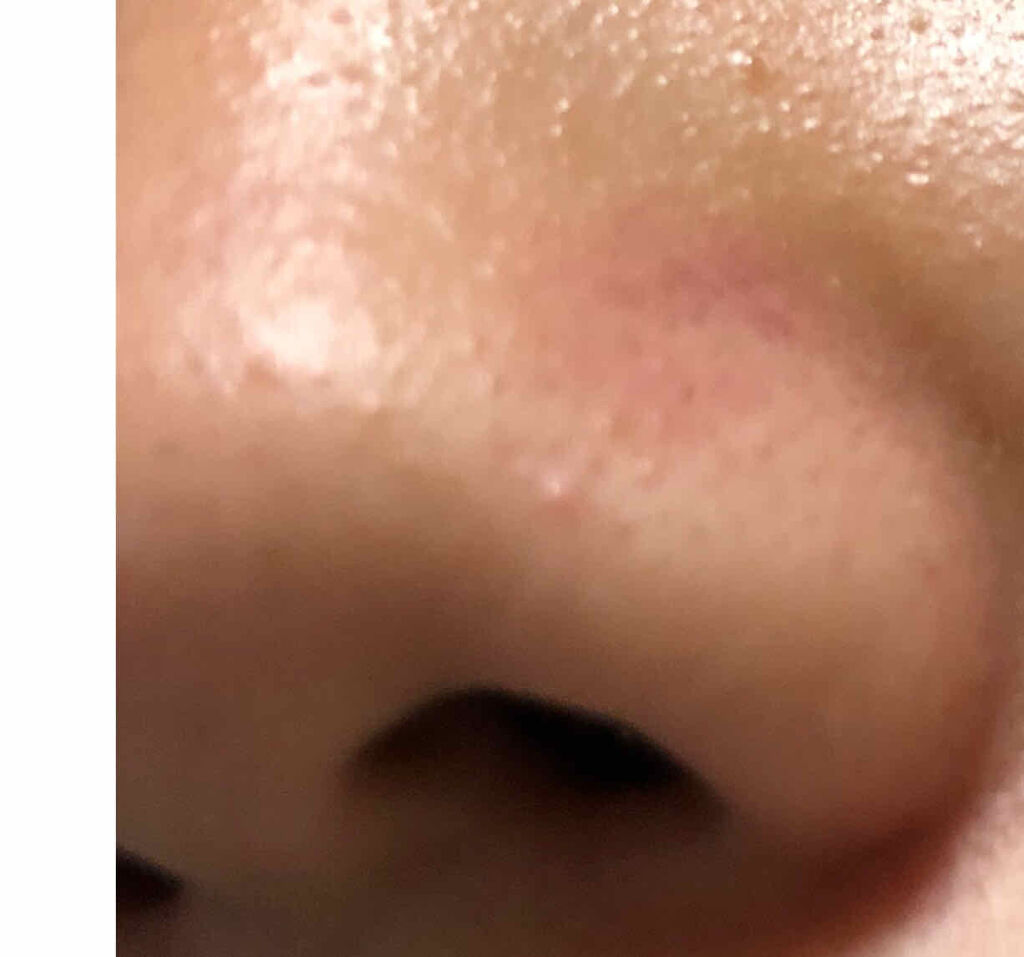 A アクネフォーム/NOV/洗顔フォームを使ったクチコミ（3枚目）