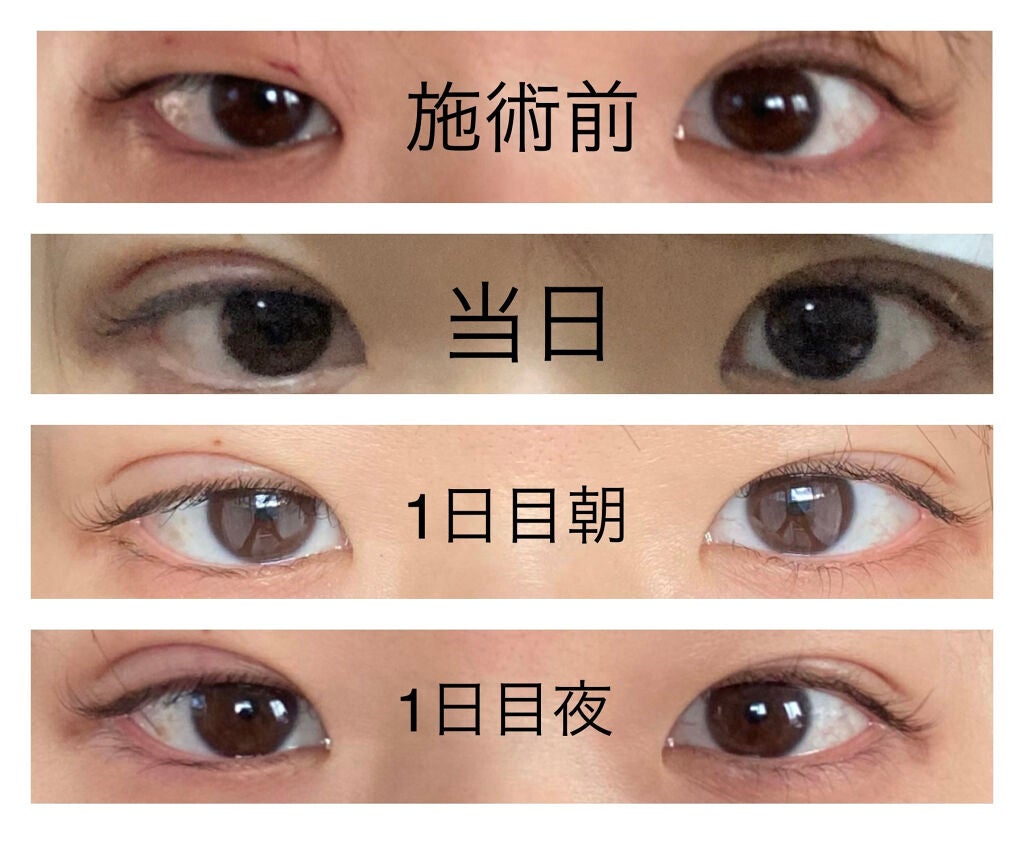 YuMi on LIPS 「埋没の再施術しました。経過まとめです。数ヶ月前に埋没施術しまし..」(3枚目)