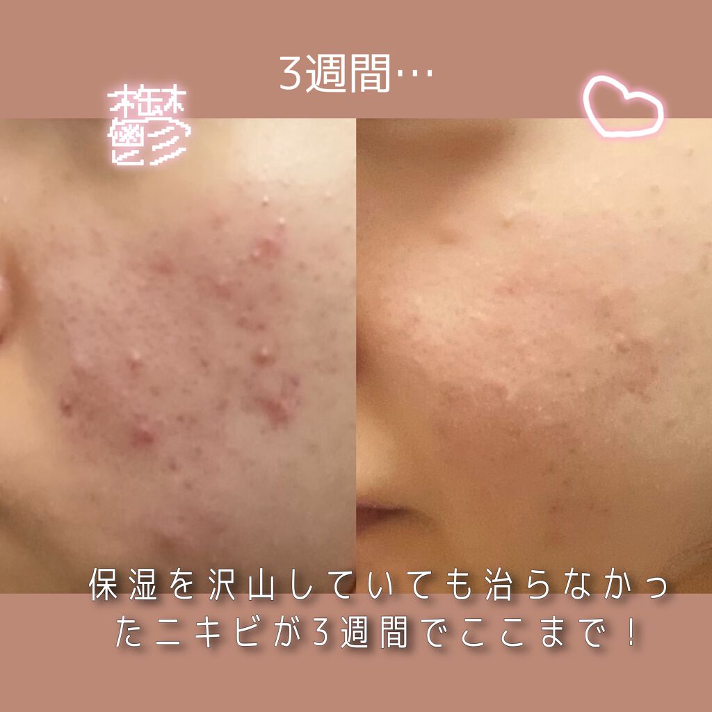 薬用しみ対策 美白化粧水 しっとりタイプ/メラノCC/化粧水を使ったクチコミ（1枚目）