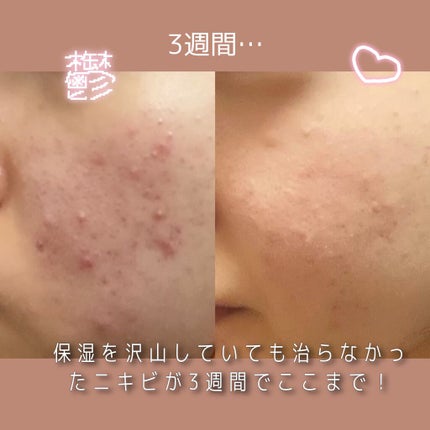 薬用しみ対策 美白化粧水 しっとりタイプ/メラノCC/化粧水を使ったクチコミ(1枚目)