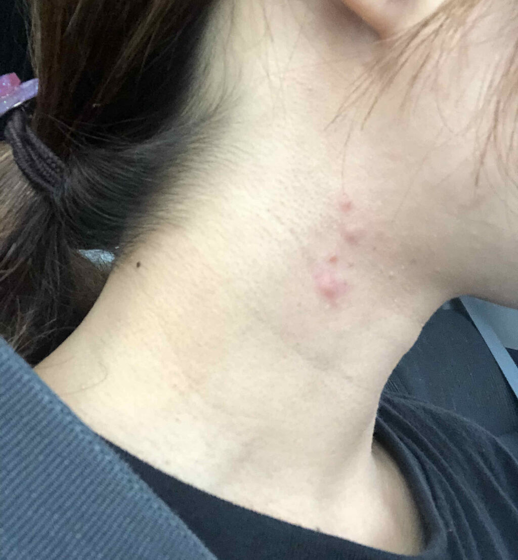 ペアアクネクリームW(医薬品)/ペア/その他を使ったクチコミ（1枚目）