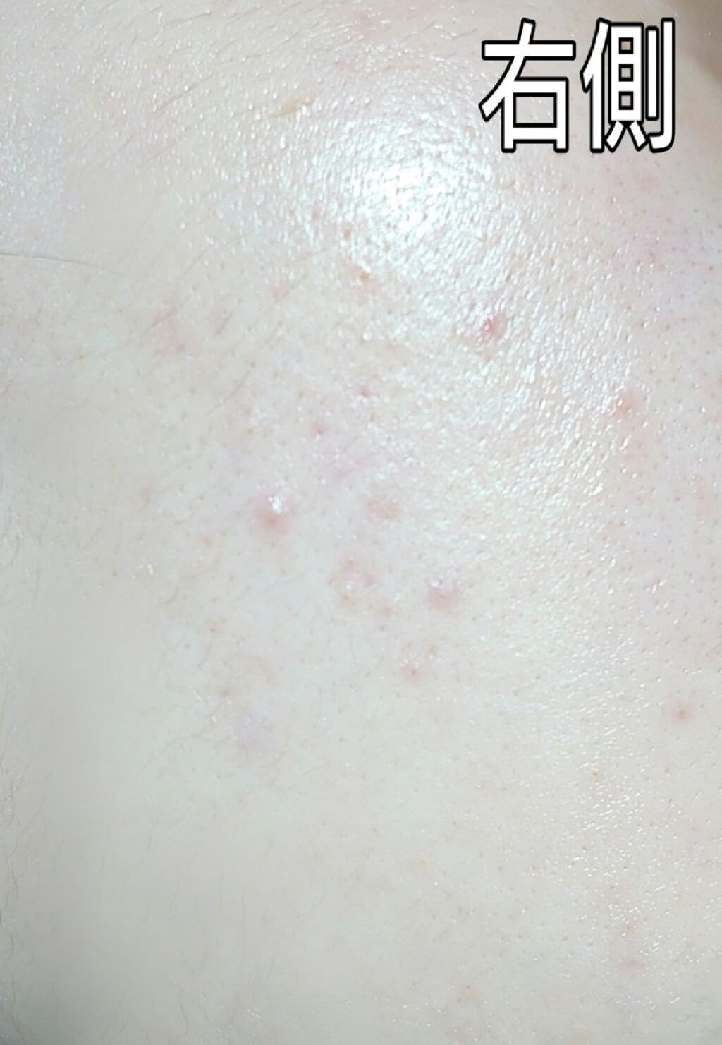 ペアアクネクリームW(医薬品)/ペア/その他を使ったクチコミ（2枚目）