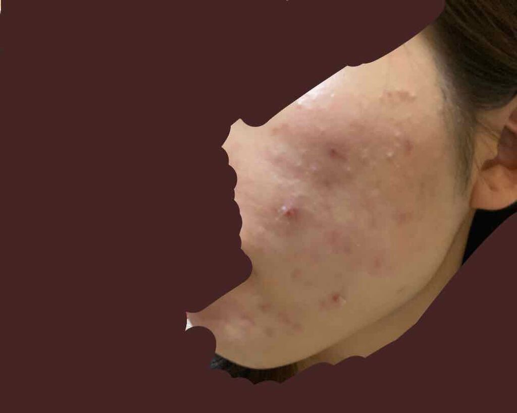 ぴい on LIPS 「【記録用】1/9皮膚科へ・エピデュオ・クリンダマイシンゲル・ヒ..」(1枚目)